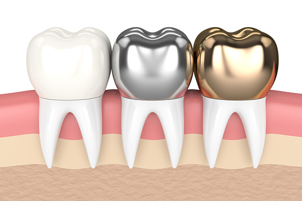 The Different Types Of Dental Implant Crown
